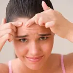 student health skin acne tips